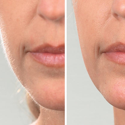 De #1 Dermaplaning Tool voor Vrouwen van 50+